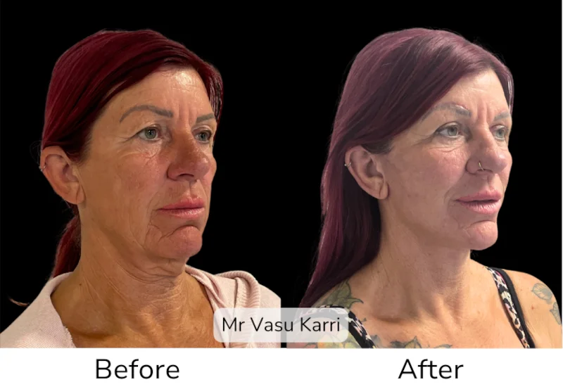 Facelift Patient 3 View 3